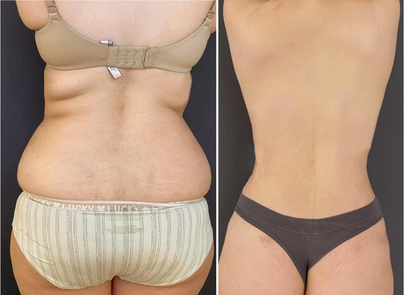 Umbareen Mahmood, MD liposuction result — New York, NY