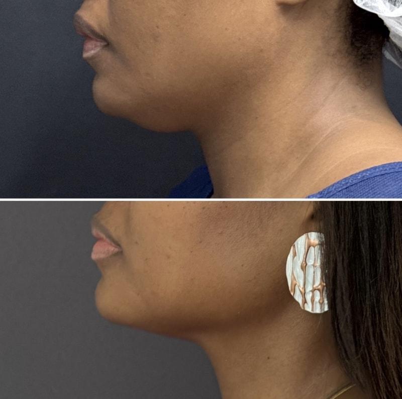 Umbareen Mahmood, MD neck liposuction result — New York, NY