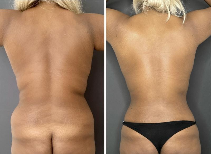 Umbareen Mahmood, MD liposuction result — New York, NY