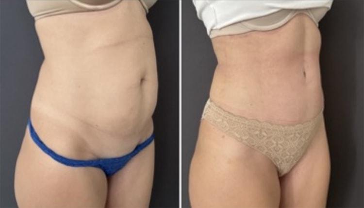 Umbareen Mahmood, MD liposuction result — New York, NY