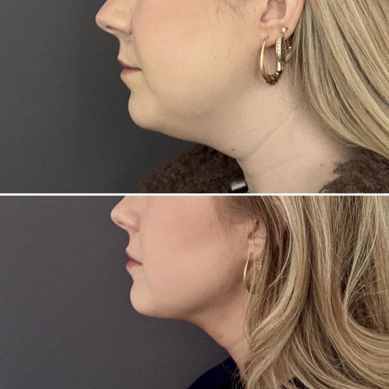 Umbareen Mahmood, MD neck liposuction result — New York, NY