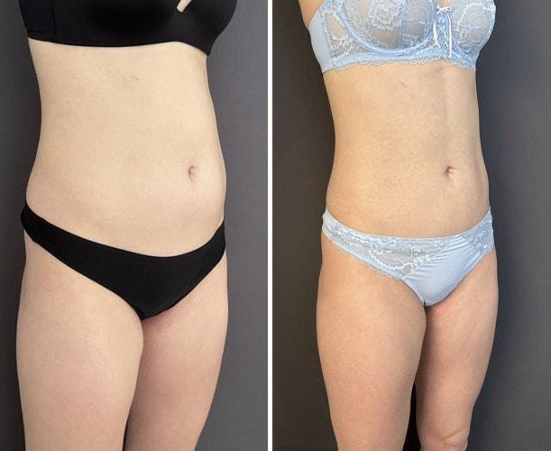 Umbareen Mahmood, MD liposuction result — New York, NY