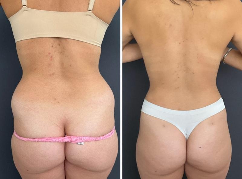 Umbareen Mahmood, MD liposuction result — New York, NY