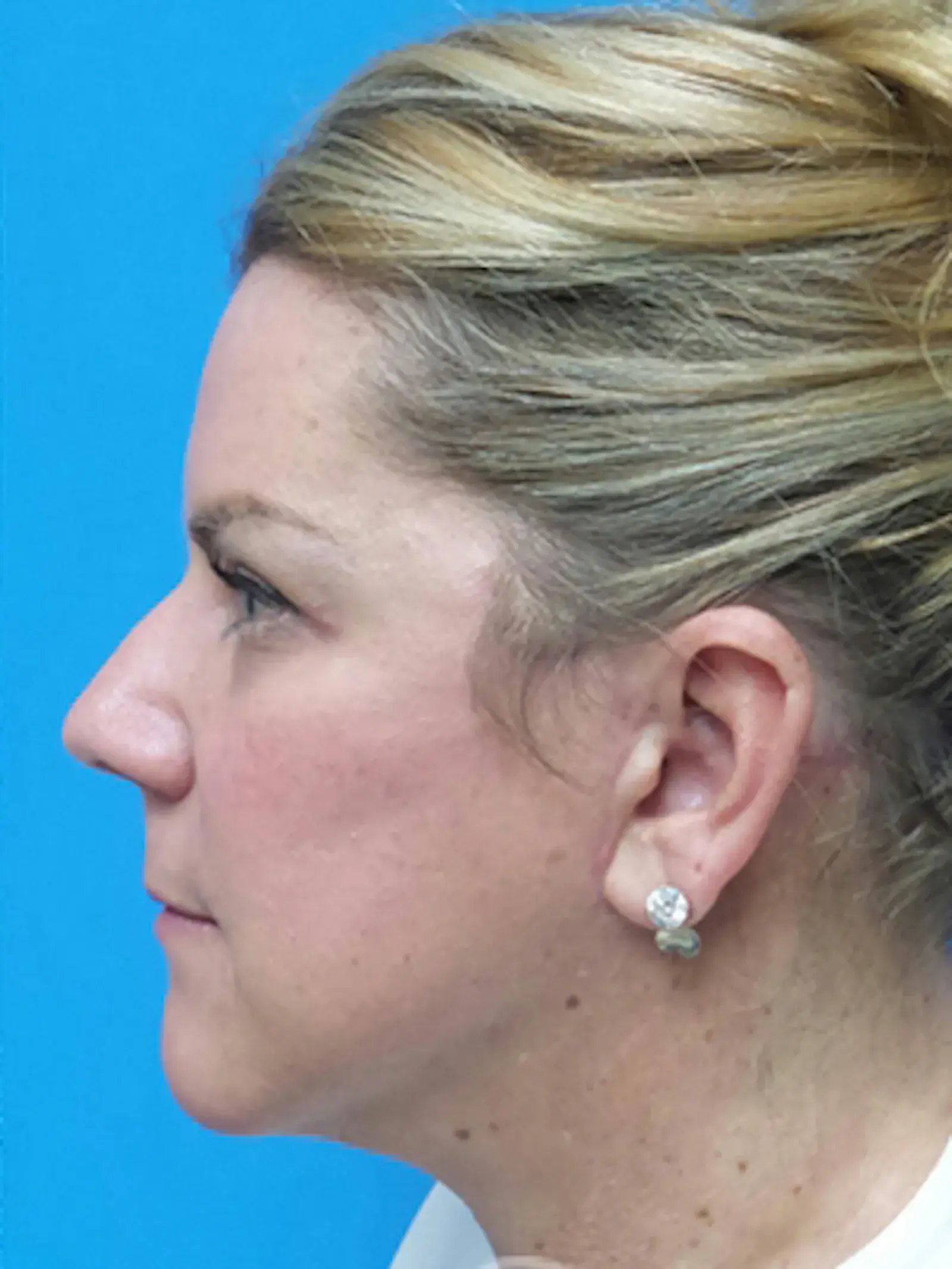 Concierge Aesthetics & Plastic Surgery - Northbrook neck lift after — Northbrook, IL