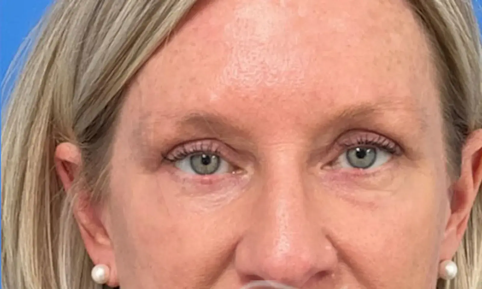 Concierge Aesthetics & Plastic Surgery - Northbrook eyelid lift after — Northbrook, IL