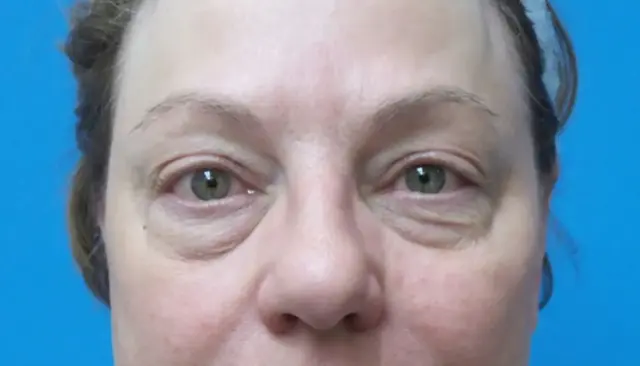 Blepharoplasty before at Concierge Aesthetics & Plastic Surgery - Northbrook in Northbrook, IL