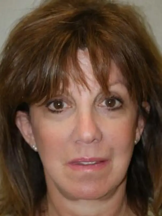Brow Lift after at Concierge Aesthetics & Plastic Surgery - Northbrook in Northbrook, IL