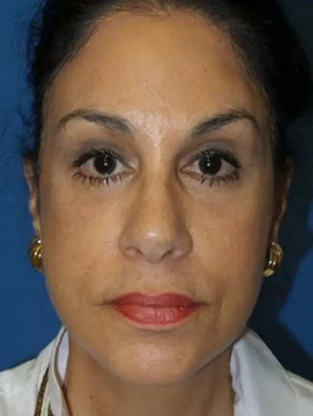 Brow Lift after at Concierge Aesthetics & Plastic Surgery - Northbrook in Northbrook, IL