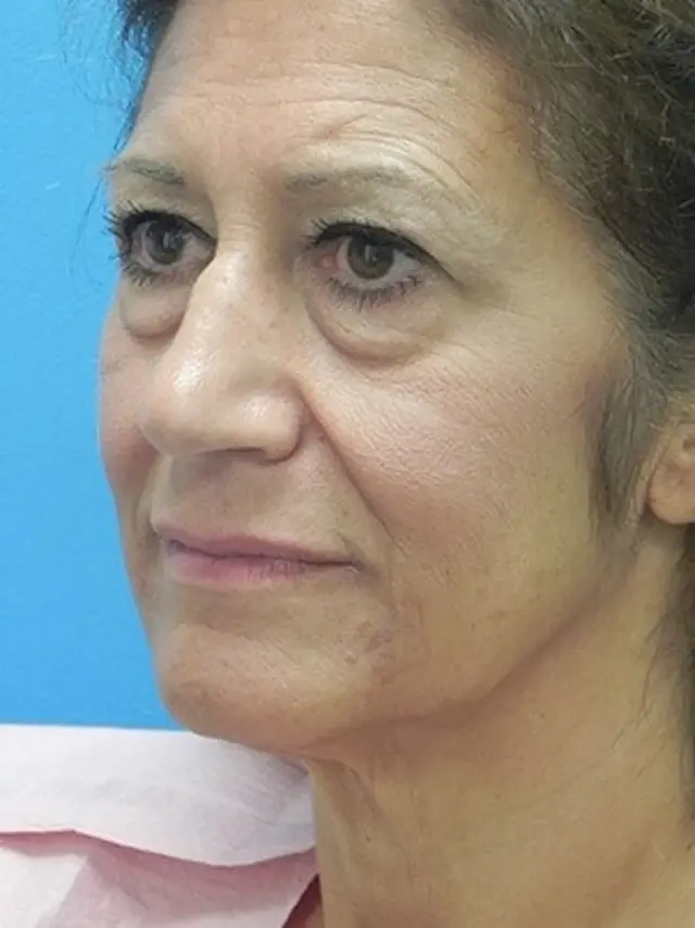 Brow Lift before at Concierge Aesthetics & Plastic Surgery - Northbrook in Northbrook, IL