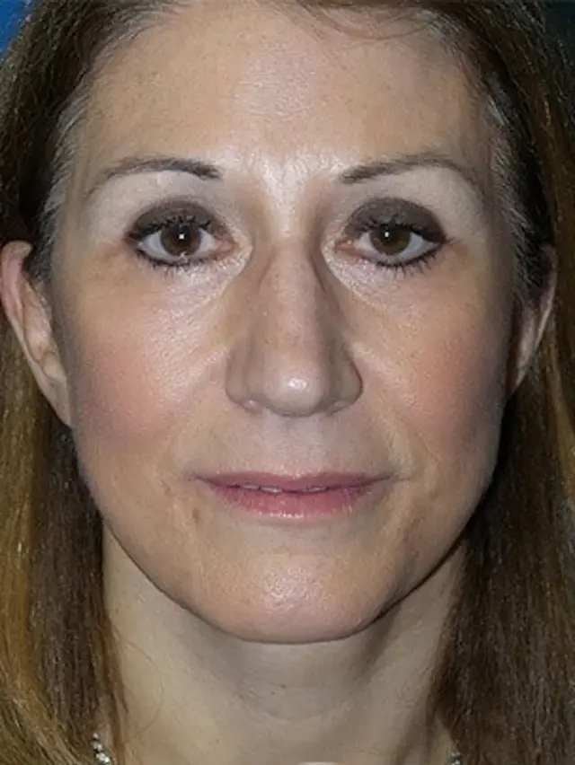 Brow Lift after at Concierge Aesthetics & Plastic Surgery - Northbrook in Northbrook, IL