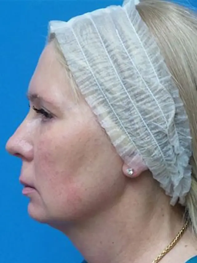 Neck Lift before at Concierge Aesthetics & Plastic Surgery - Northbrook in Northbrook, IL