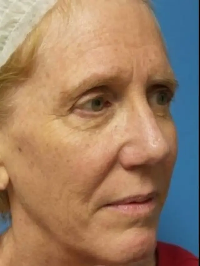 Brow Lift before at Concierge Aesthetics & Plastic Surgery - Northbrook in Northbrook, IL