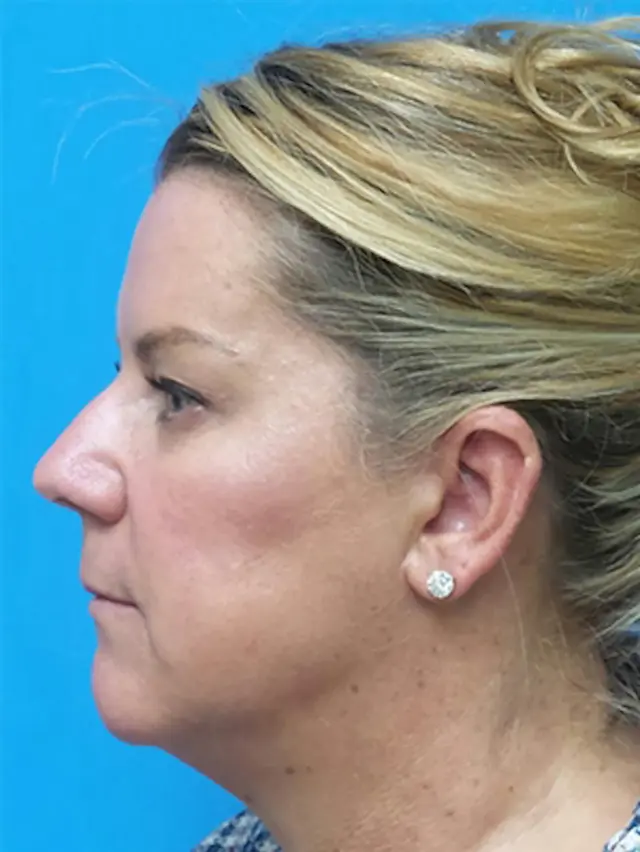 Neck Lift before at Concierge Aesthetics & Plastic Surgery - Northbrook in Northbrook, IL