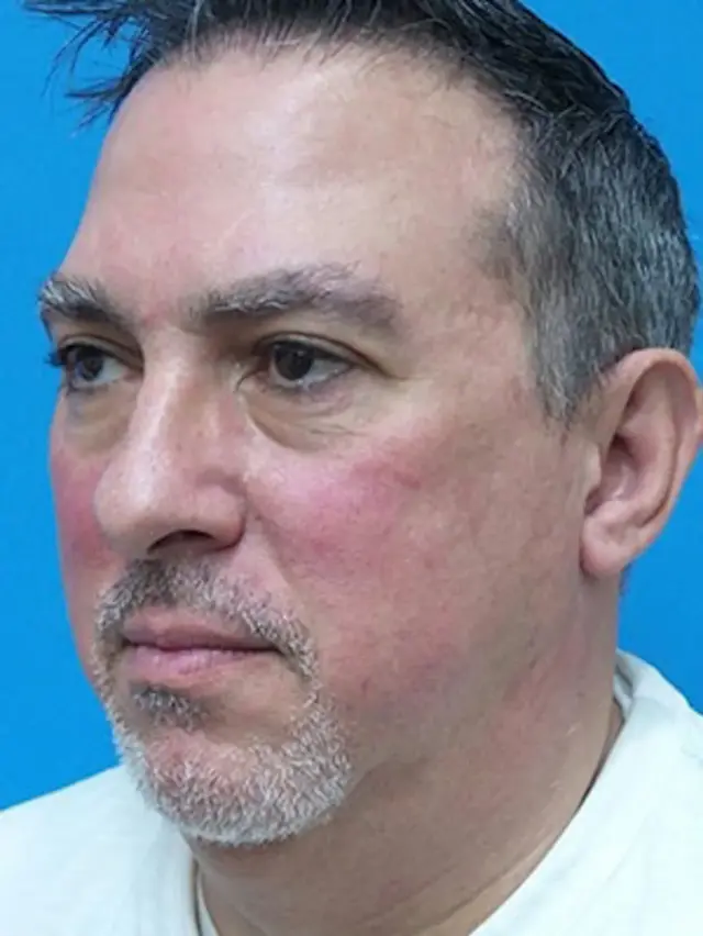 Neck Lift before at Concierge Aesthetics & Plastic Surgery - Northbrook in Northbrook, IL