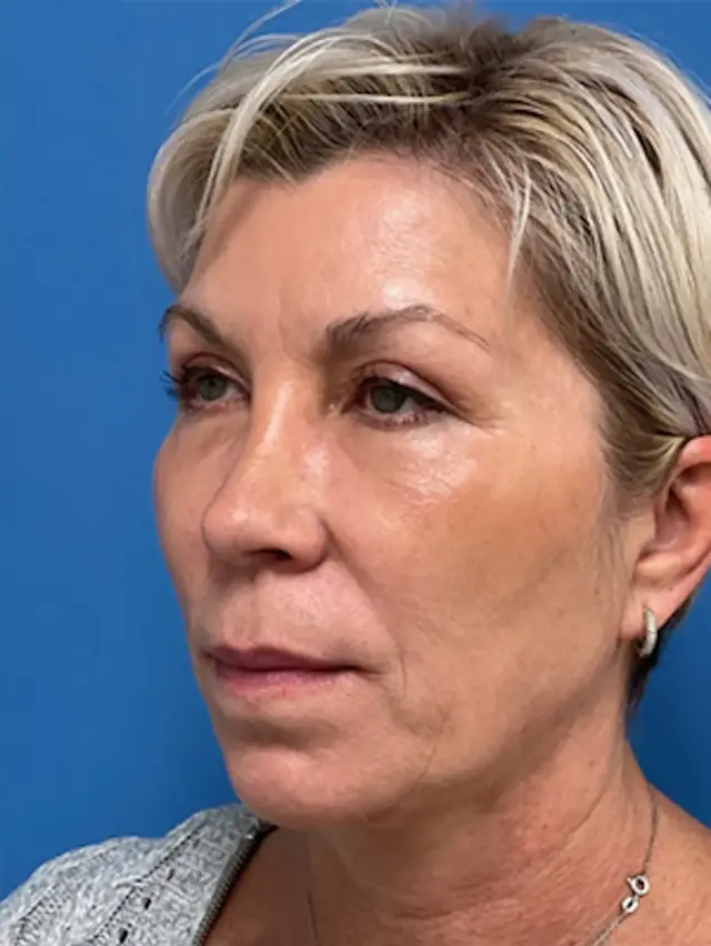 Neck Lift after at Concierge Aesthetics & Plastic Surgery - Northbrook in Northbrook, IL