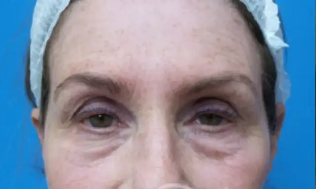 Blepharoplasty before at Concierge Aesthetics & Plastic Surgery - Northbrook in Northbrook, IL
