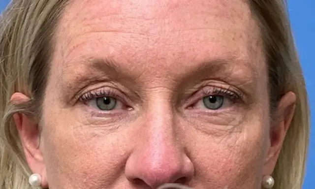 Blepharoplasty before at Concierge Aesthetics & Plastic Surgery - Northbrook in Northbrook, IL