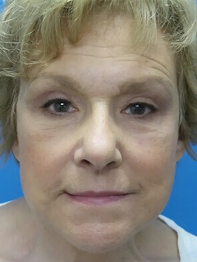 Brow Lift after at Concierge Aesthetics & Plastic Surgery - Northbrook in Northbrook, IL