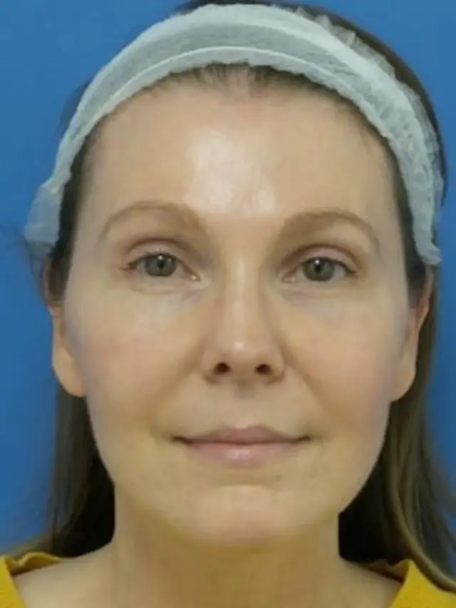 Brow Lift after at Concierge Aesthetics & Plastic Surgery - Northbrook in Northbrook, IL