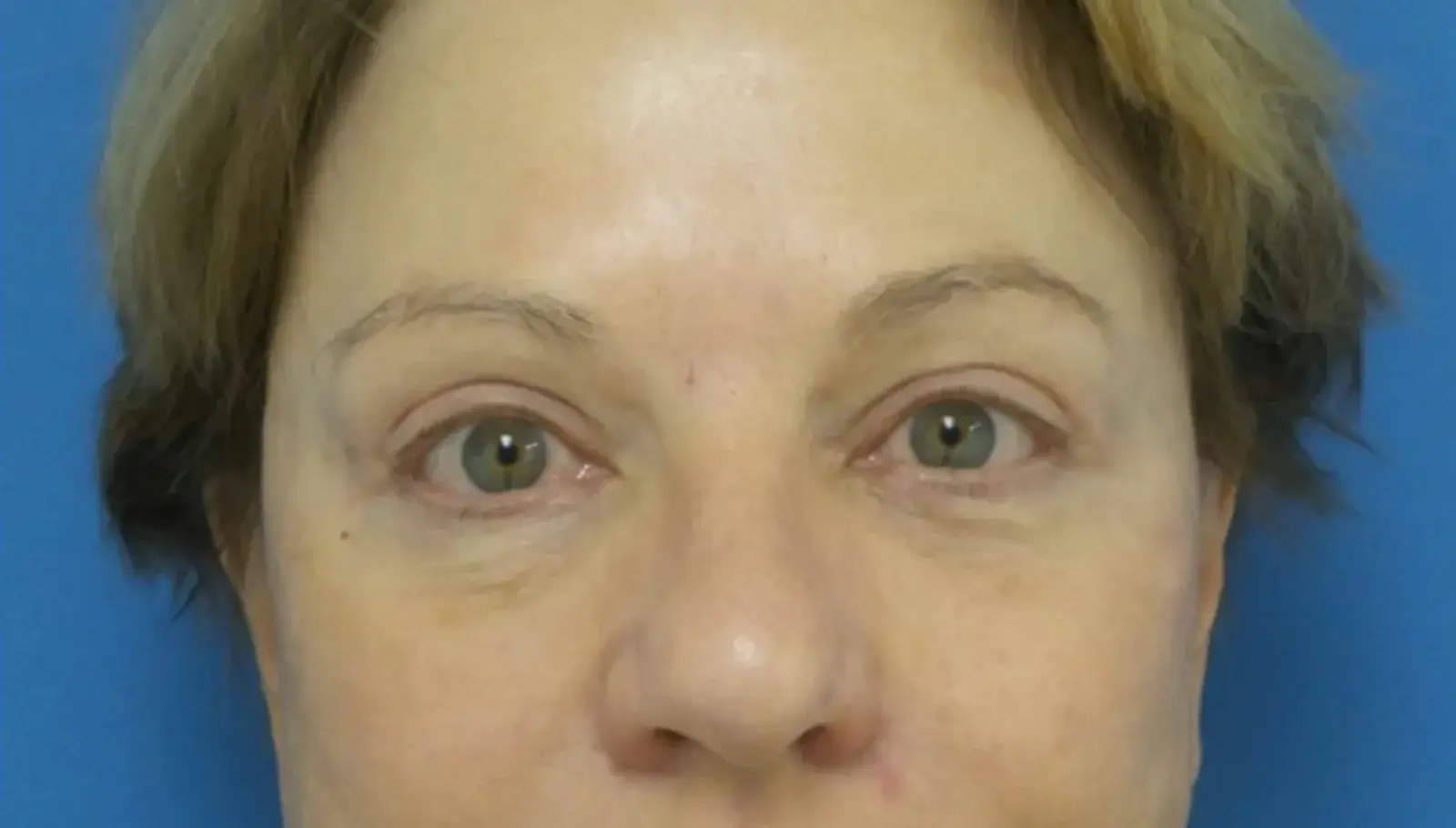 Concierge Aesthetics & Plastic Surgery - Northbrook eyelid lift after — Northbrook, IL