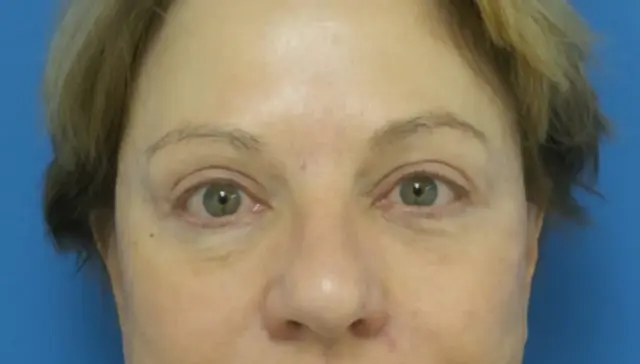 Blepharoplasty after at Concierge Aesthetics & Plastic Surgery - Northbrook in Northbrook, IL
