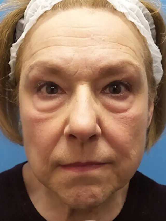 Brow Lift before at Concierge Aesthetics & Plastic Surgery - Northbrook in Northbrook, IL