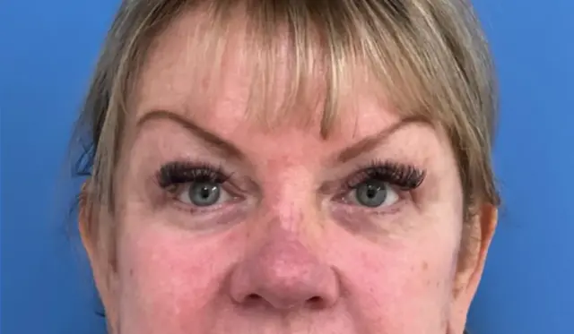 Blepharoplasty after at Concierge Aesthetics & Plastic Surgery - Northbrook in Northbrook, IL