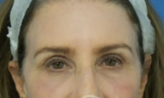 Blepharoplasty after at Concierge Aesthetics & Plastic Surgery - Northbrook in Northbrook, IL
