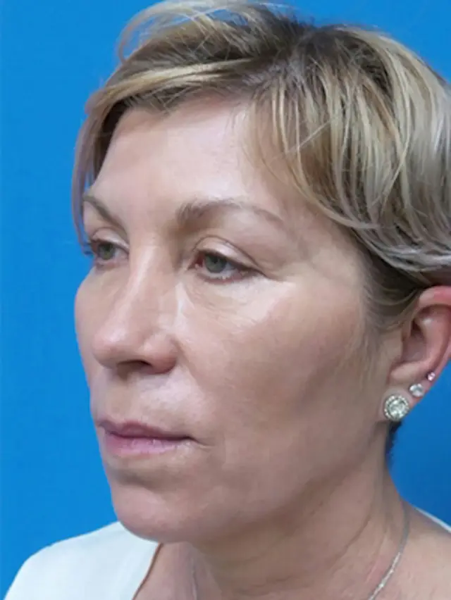 Neck Lift before at Concierge Aesthetics & Plastic Surgery - Northbrook in Northbrook, IL