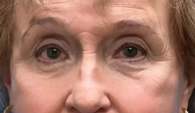 Blepharoplasty after at Concierge Aesthetics & Plastic Surgery - Northbrook in Northbrook, IL