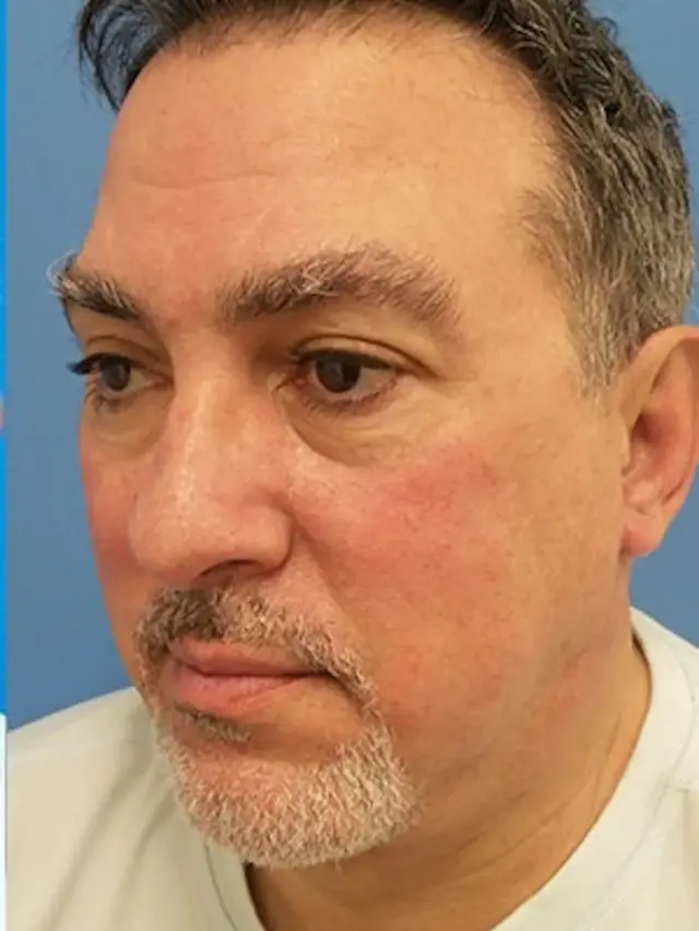 Neck Lift after at Concierge Aesthetics & Plastic Surgery - Northbrook in Northbrook, IL