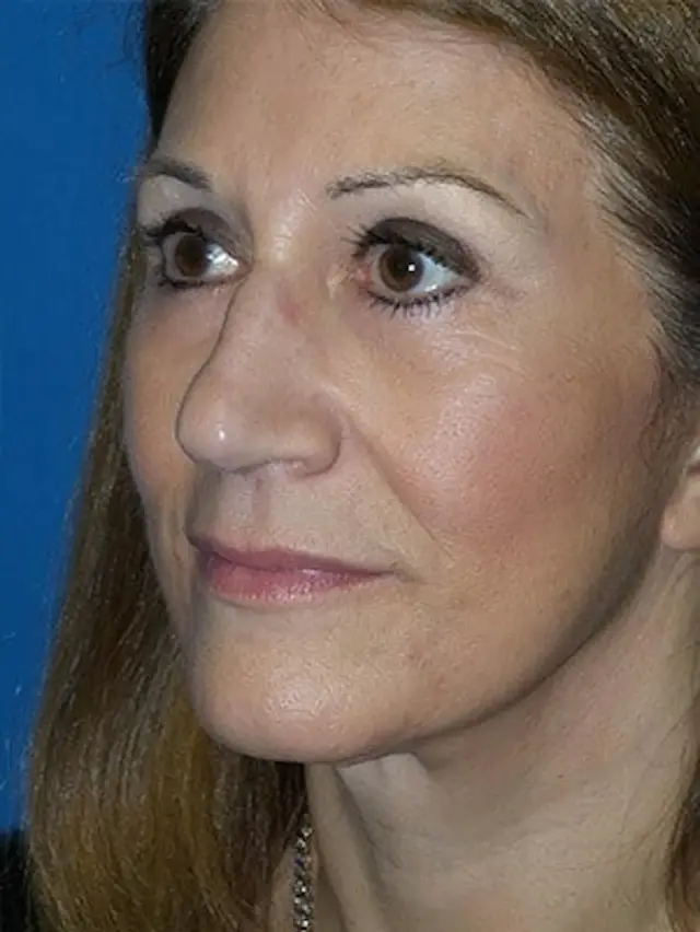 Brow Lift after at Concierge Aesthetics & Plastic Surgery - Northbrook in Northbrook, IL