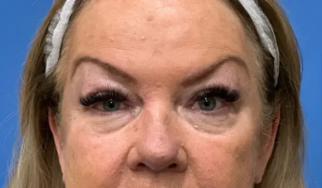 Blepharoplasty before at Concierge Aesthetics & Plastic Surgery - Northbrook in Northbrook, IL