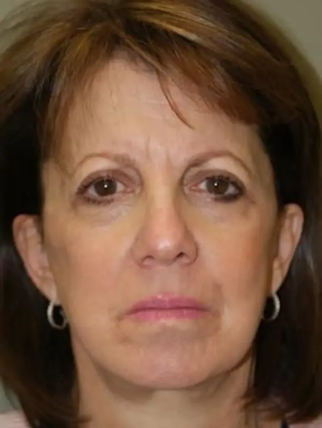 Brow Lift before at Concierge Aesthetics & Plastic Surgery - Northbrook in Northbrook, IL