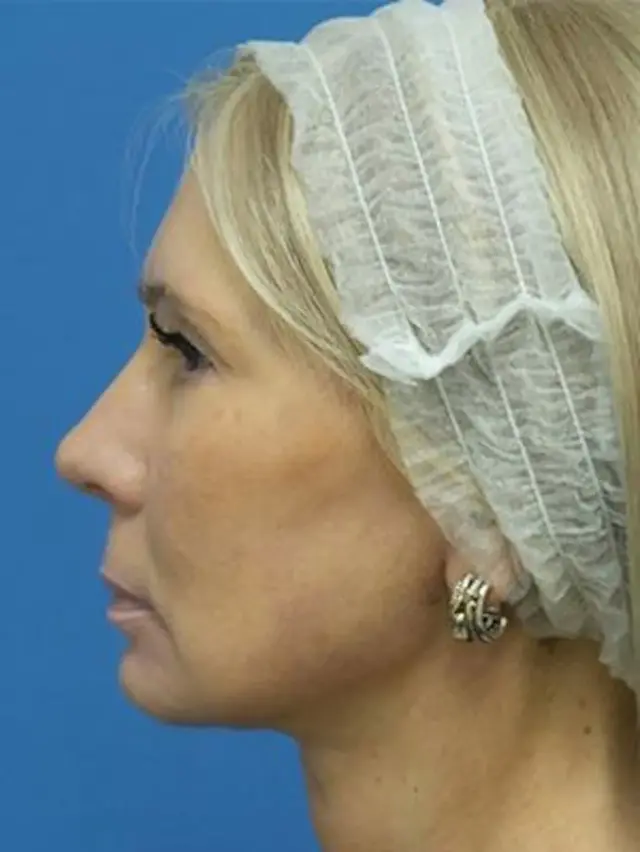 Neck Lift after at Concierge Aesthetics & Plastic Surgery - Northbrook in Northbrook, IL