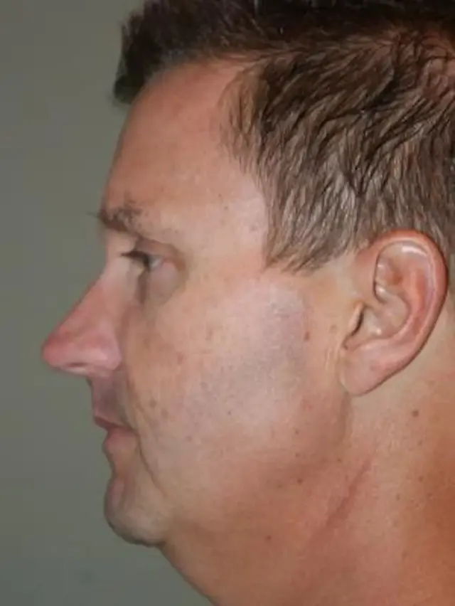Neck Lift before at Concierge Aesthetics & Plastic Surgery - Northbrook in Northbrook, IL