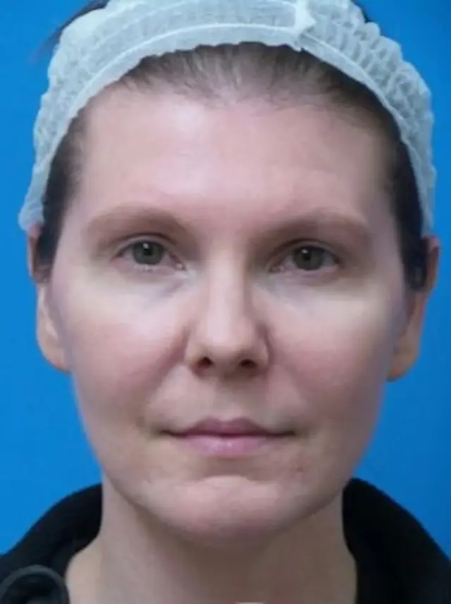 Brow Lift before at Concierge Aesthetics & Plastic Surgery - Northbrook in Northbrook, IL