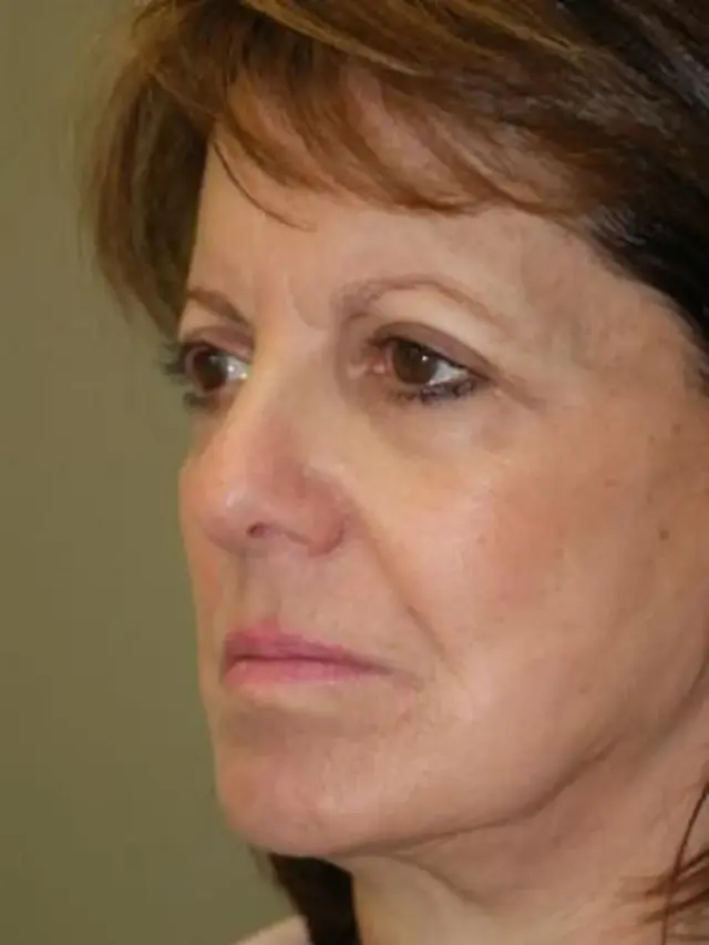 Brow Lift before at Concierge Aesthetics & Plastic Surgery - Northbrook in Northbrook, IL