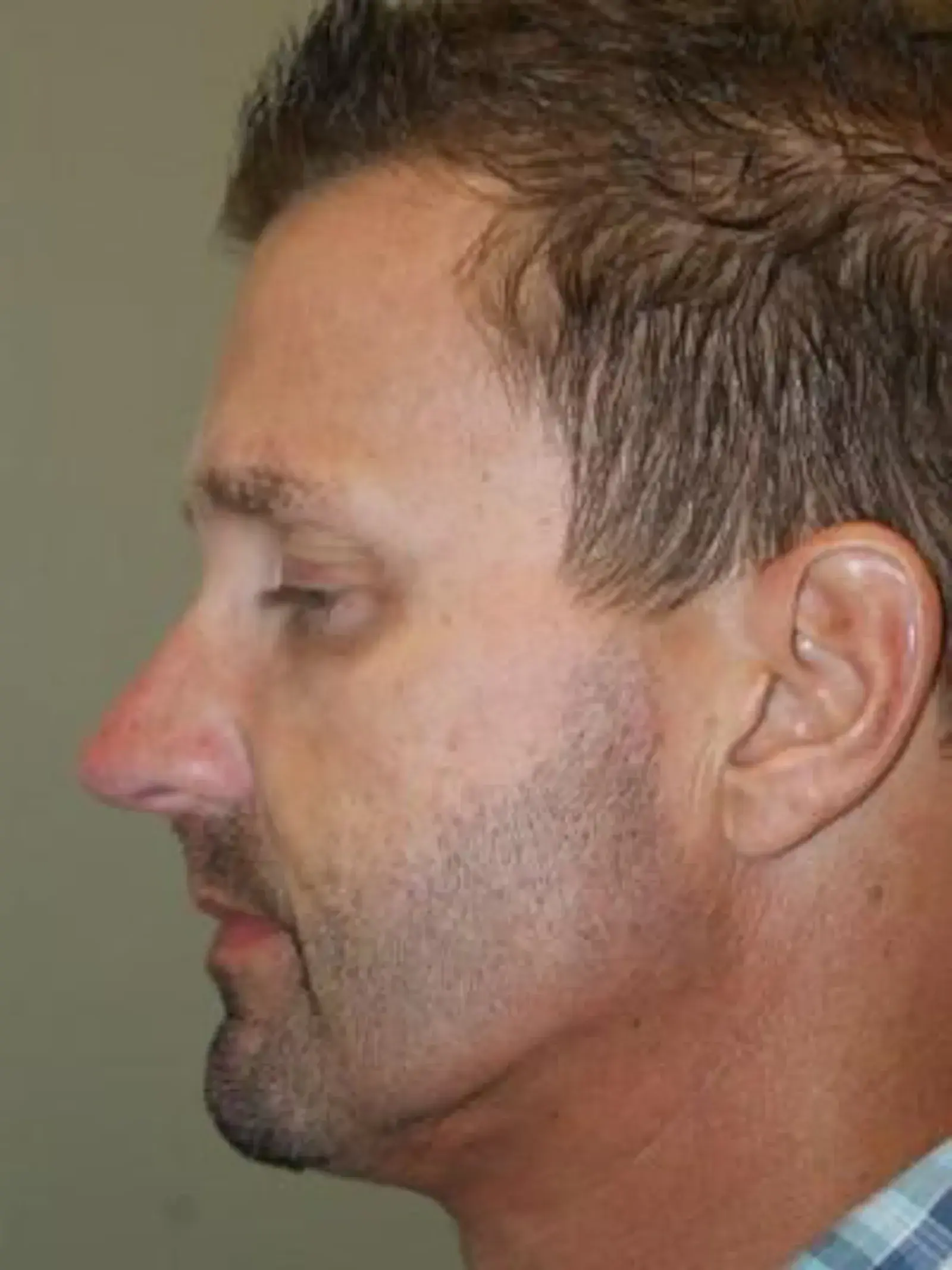 Concierge Aesthetics & Plastic Surgery - Northbrook neck lift after — Northbrook, IL