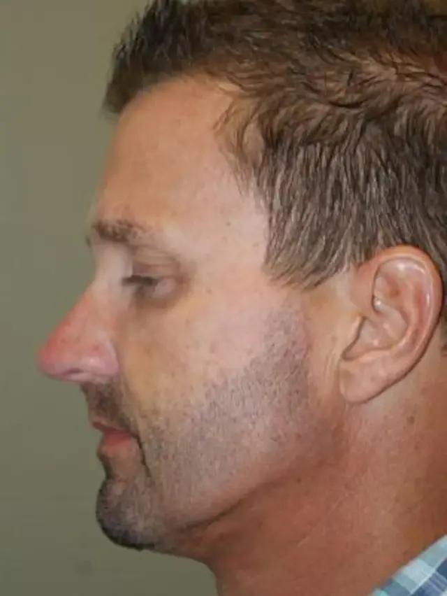 Neck Lift after at Concierge Aesthetics & Plastic Surgery - Northbrook in Northbrook, IL
