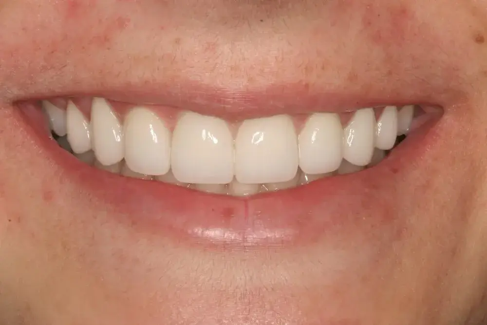 D'Angelo/Olson La Jolla Dentistry veneers after — San Diego, CA
