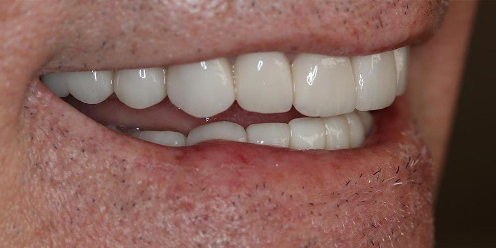 D'Angelo/Olson La Jolla Dentistry smile makeover after — San Diego, CA