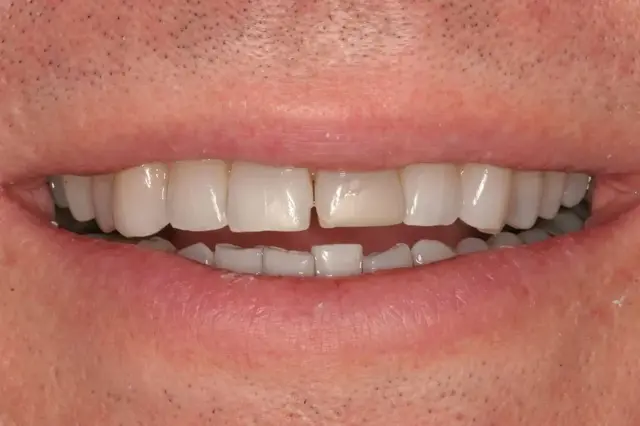 Smile Makeover before at D'Angelo/Olson La Jolla Dentistry in San Diego, CA