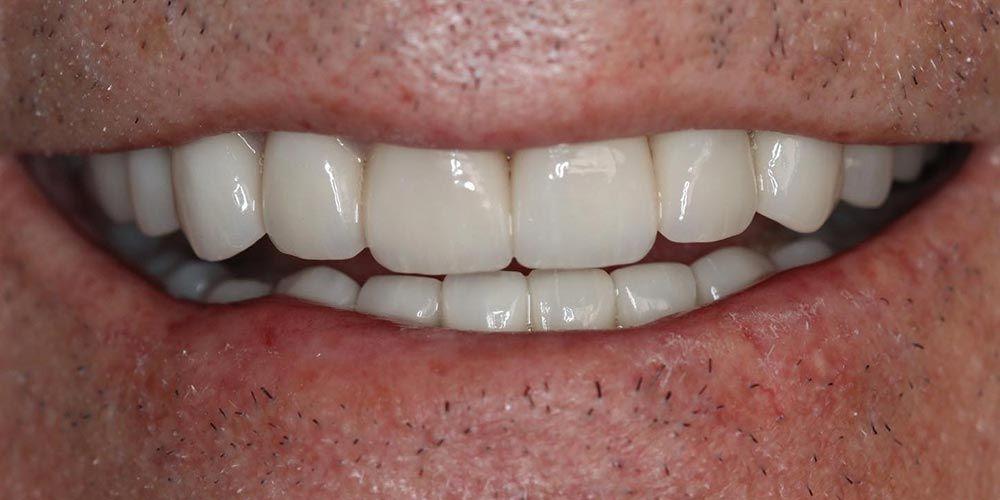 D'Angelo/Olson La Jolla Dentistry smile makeover after — San Diego, CA