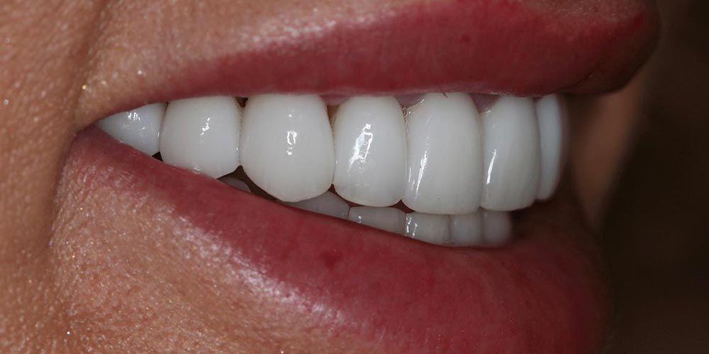 D'Angelo/Olson La Jolla Dentistry smile makeover after — San Diego, CA