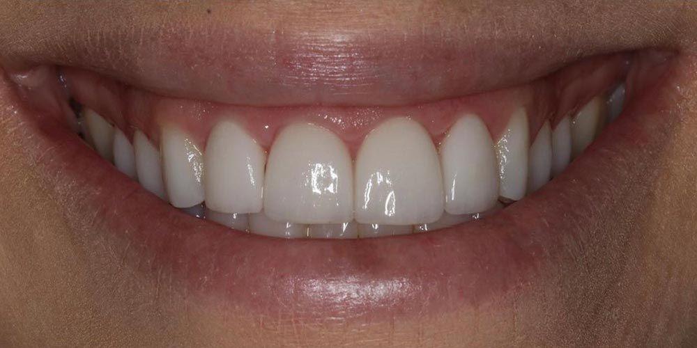 D'Angelo/Olson La Jolla Dentistry smile makeover after — San Diego, CA