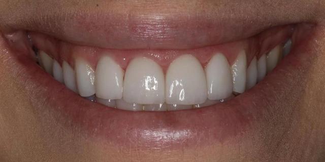 Smile Makeover after at D'Angelo/Olson La Jolla Dentistry in San Diego, CA
