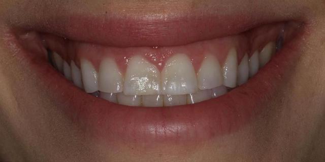 Smile Makeover before at D'Angelo/Olson La Jolla Dentistry in San Diego, CA