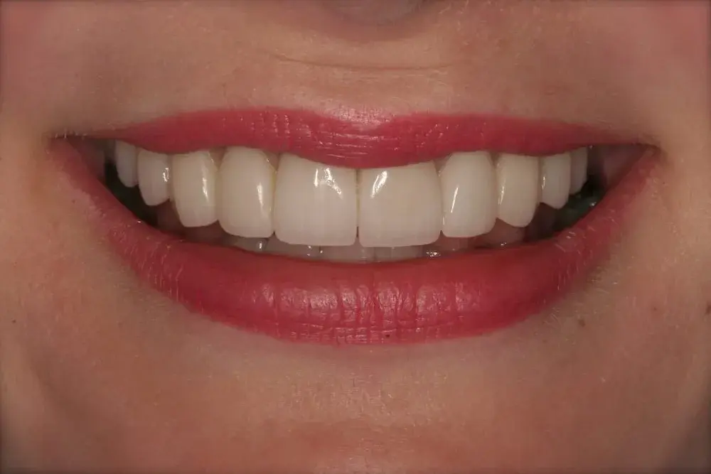 D'Angelo/Olson La Jolla Dentistry veneers after — San Diego, CA