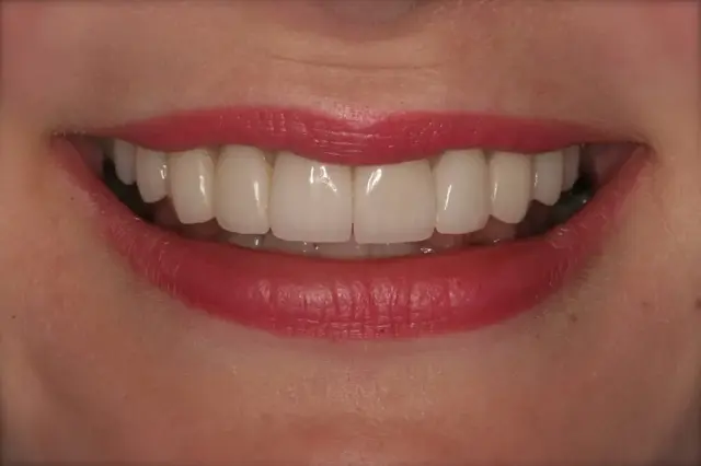 Dental Veneers after at D'Angelo/Olson La Jolla Dentistry in San Diego, CA